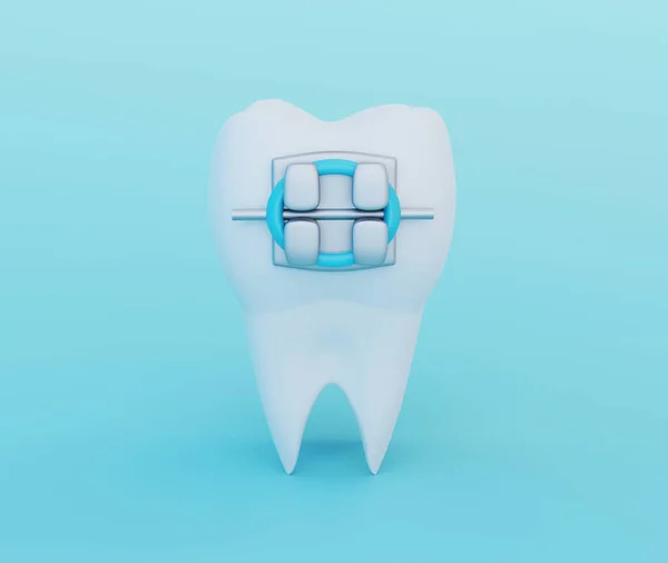 Dente Com Aparelho Metálico Sobre Fundo Azul Cuidados Símbolos Ortodontia — Fotografia de Stock