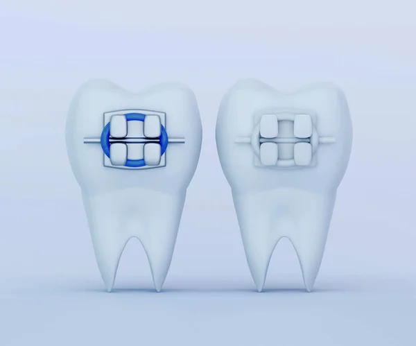Biały Przejrzysty Ząb Metalowym Aparatem Zęby Ceramicznym Aparatem Zęby Porównanie — Zdjęcie stockowe