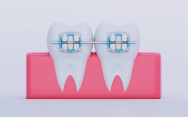 Sakızında metal diş teli olan iki diş. Dikkat, Ortodonti ve Diş Hekimliği sembolleri, 3B oluşturma