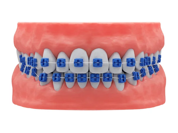 Mâchoires Humaines Réalistes Avec Des Dents Des Appareils Dentaires Sains — Photo