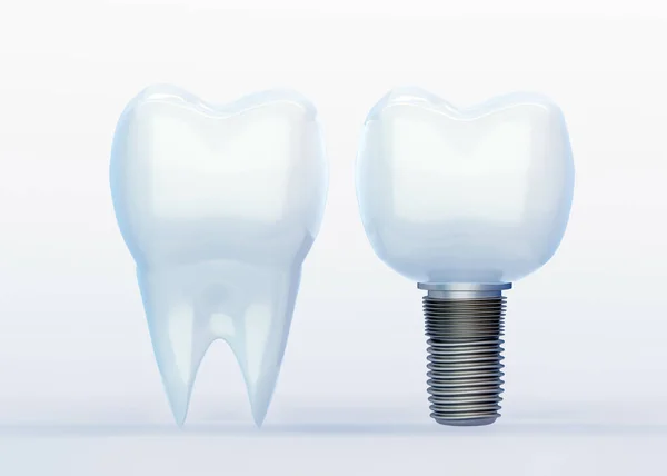 White Tooth Tooth Implant White Background Artificial Tooth Render — Stock Photo, Image