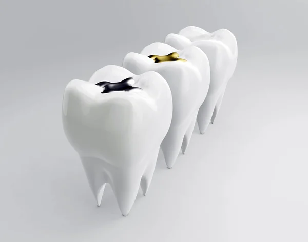 Dientes Con Relleno Dental Con Incrustaciones Oro Amalgama Compuesto Molares — Foto de Stock