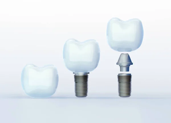 Beyaz arka planda diş ve diş implantları, yapay diş, 3D görüntüleme.
