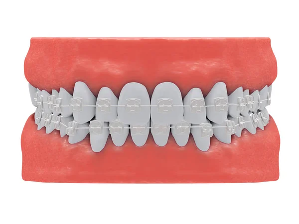 Lidské Čelisti Zdravými Zuby Neviditelnými Keramickými Rovnátky Pohled Zepředu Vykreslování — Stock fotografie