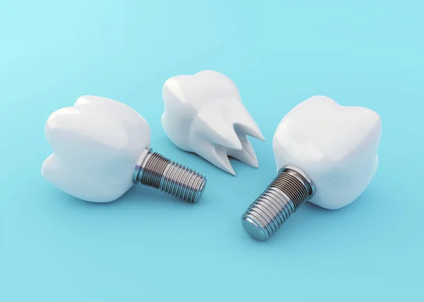 Implantes Dentários Coroa Dentes Fundo Azul Dentes Artificiais Conceito Implantação — Fotografia de Stock