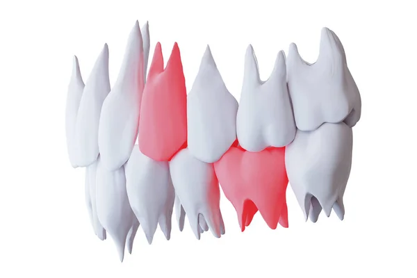 痛みを伴う歯を持つ人間の歯 赤の下の6番目と上の4番目の臼歯 白に隔離された サイドビュー 3Dレンダリング — ストック写真