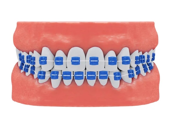 Lidské Čelisti Zdravými Zuby Modrými Rovnátky Pohled Zepředu Izolovaný Vykreslení — Stock fotografie