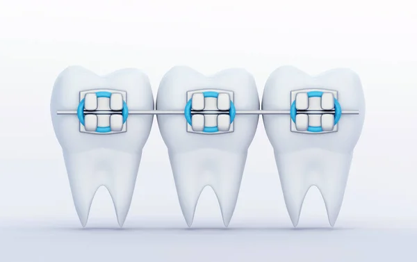 Trzy Zęby Metalowym Aparatem Zęby Pielęgnacja Ortodoncja Symbole Stomatologiczne Renderowanie — Zdjęcie stockowe