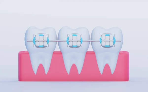 Trzy Zęby Metalowym Aparatem Zębach Gumie Pielęgnacja Ortodoncja Symbole Stomatologiczne — Zdjęcie stockowe