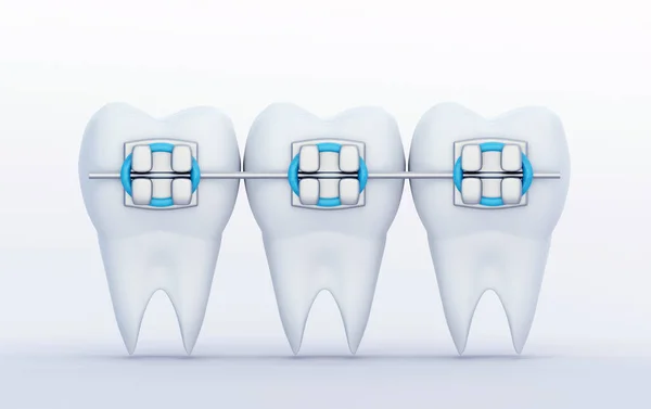 Tiga Gigi Dengan Metal Braces Care Ortodontik Dan Dentistry Simbol — Stok Foto