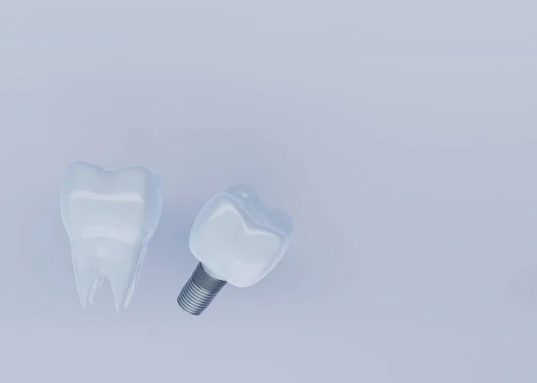 Δόντι Crown Και Οδοντιατρική Εμφύτευση Γκρι Φόντο Αντίγραφο Χώρο Οδοντιατρική — Φωτογραφία Αρχείου