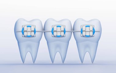 Metal diş telli üç diş. Dikkat, Ortodonti ve Diş Hekimliği sembolleri, 3B oluşturma