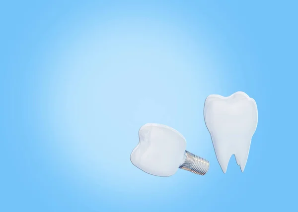 Δόντι στέμμα και εμφυτεύματα δοντιών σε μπλε φόντο με αντίγραφο χώρου, τεχνητό δόντι, 3d καθιστούν — Φωτογραφία Αρχείου
