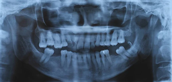 Imagem Panorâmica Raios Dentários Mandibulares — Fotografia de Stock