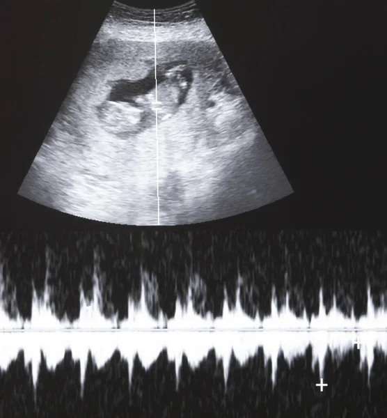 Ultrasound Fetus Heart Beat Graph — Stok Foto