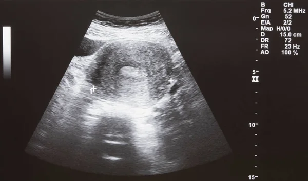 Ultrasound Bayi Pada Wanita Hamil — Stok Foto