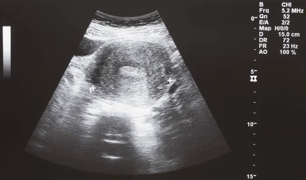 Узи Ребенка Беременной Женщины — стоковое фото