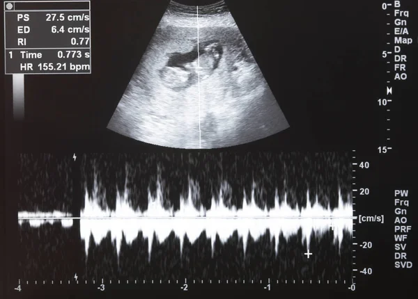 Usg Dziecka Kobiety Ciąży Wykresem Rytmu Serca — Zdjęcie stockowe