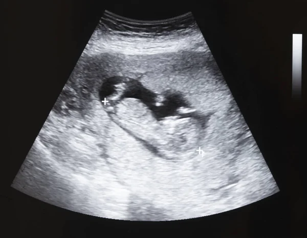 Ultrasound Baby Pregnant Woman — Stock Photo, Image