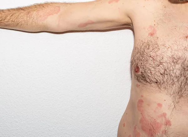 Man with dermatitis problem of rash. Allergy rash. Histamine reaction