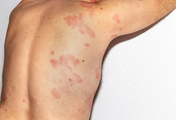 Man with dermatitis problem of rash. Allergy rash. Histamine reaction