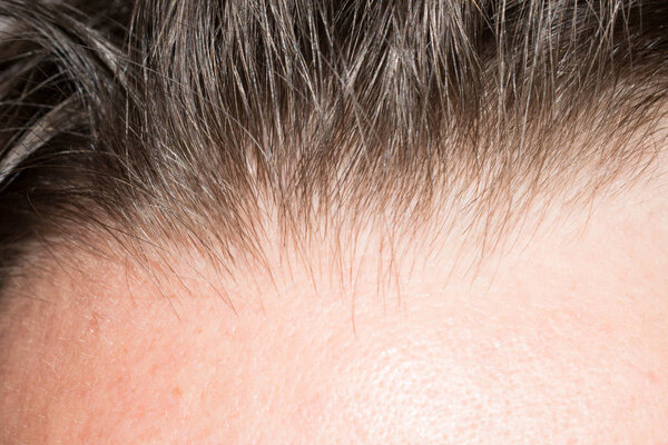 Hair on the head of a man thin brittle rare prollysiny for medicine design background back