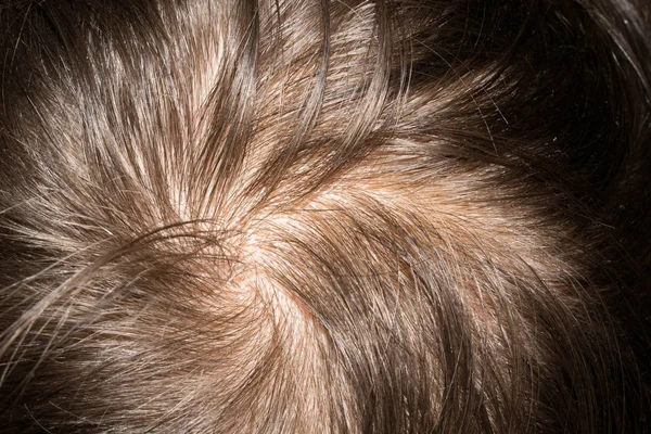 Hair Head Man Thin Brittle Rare Prollysiny Medicine Design Background — Stock Photo, Image