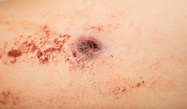 BCG vaccination in a child is rotting open wound with blood for medicine design