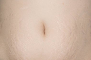 Büyük ilaç tasarımı için doğumdan sonra kadının karın deri çatlakları