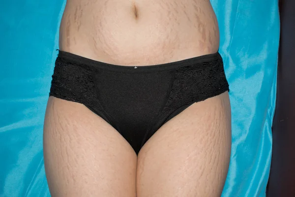 Stretch marks large on the skin of the legs of the abdomen of the woman after giving birth for design