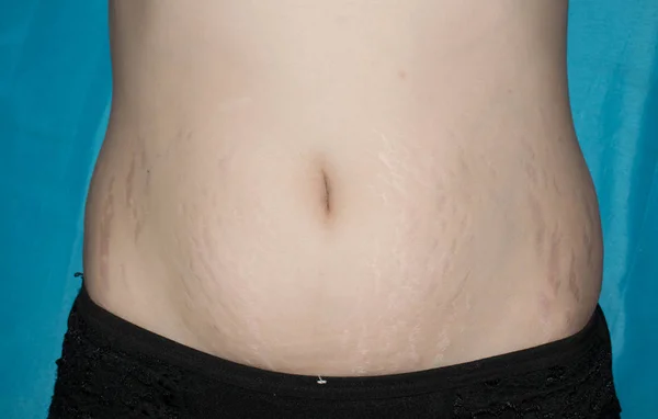 Stretch Marks Stora Huden Buken Kvinnan Efter Förlossning För Medicin — Stockfoto