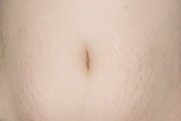 Terhességi Csíkok Bőr Has Nagy Gyógyszer Design Szülés Után — Stock Fotó