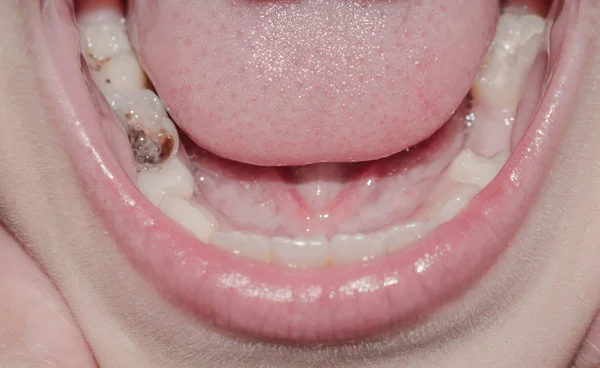 Primární Zuby Mléka Padají Černou Nakaženou Karí Pro Medicínu — Stock fotografie