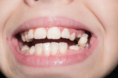 Birincil süt dişleri ilaç için çürük ile enfekte break kararmaya düşmek