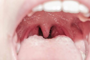 Gırtlak boğaz bezleri dil viral lingitis iltihabı ilaç için bademcikağız