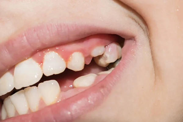 Primární Zuby Mléka Padají Černou Nakaženou Karí Pro Medicínu — Stock fotografie