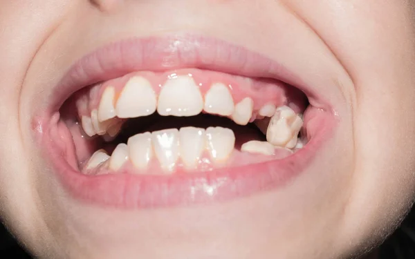 Primaria Dientes Leche Caen Rotura Color Negro Infectado Con Caries — Foto de Stock