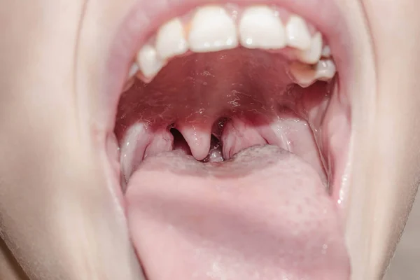 喉頭咽喉腺舌ウイルス性言語炎症薬用扁桃口の炎症 — ストック写真