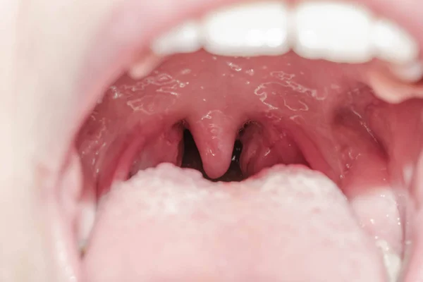 Laringe Garganta Glándulas Lengua Lingitis Viral Inflamación Las Amígdalas Boca — Foto de Stock