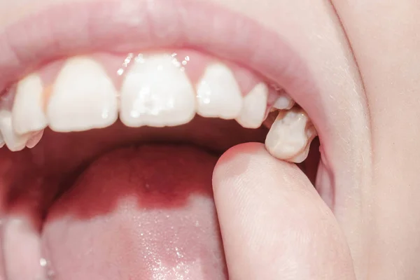 Primaria Dientes Leche Caen Rotura Color Negro Infectado Con Caries — Foto de Stock