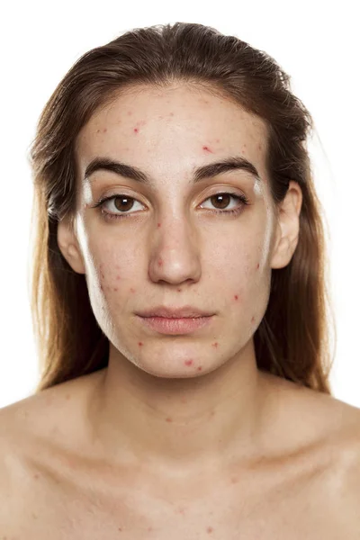 Jovem Com Pele Problemática Sem Maquiagem Posando Fundo Branco — Fotografia de Stock