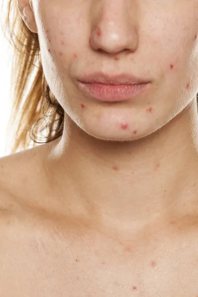Demi Visage Une Jeune Femme Peau Problématique Sans Maquillage Posant — Photo