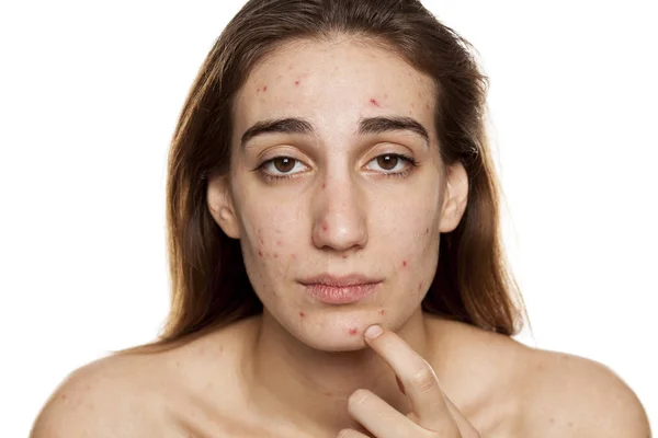 Młoda Kobieta Skórą Problematyczną Bez Makijażu Pozowanie Białym Tle — Zdjęcie stockowe