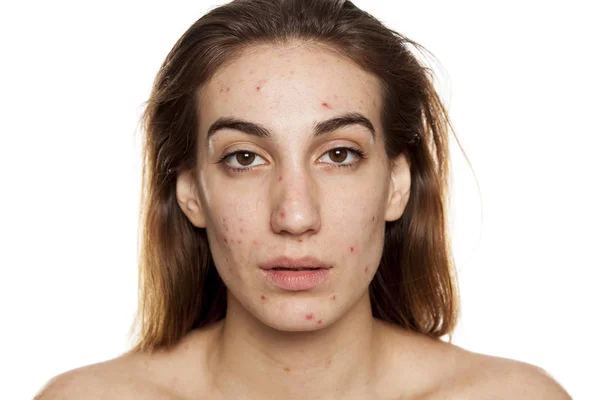 Jeune Femme Avec Peau Problématique Sans Maquillage Posant Sur Fond — Photo