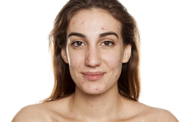 Joven Mujer Sonriente Con Piel Problemática Sin Maquillaje Posando Sobre —  Fotos de Stock
