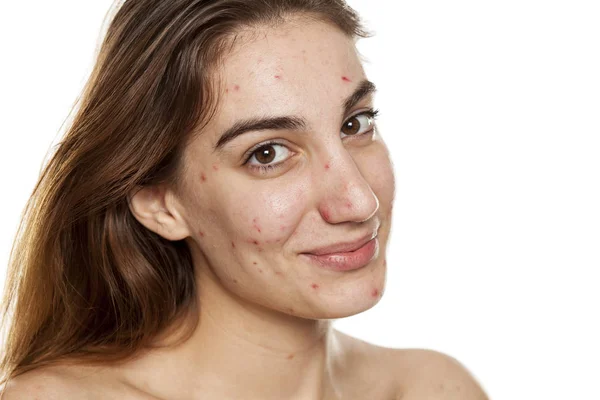 Jovem Mulher Sorridente Com Pele Problemática Sem Maquiagem Posando Fundo — Fotografia de Stock
