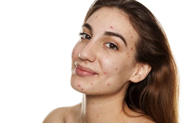 Jeune Femme Souriante Avec Peau Problématique Sans Maquillage Posant Sur — Photo