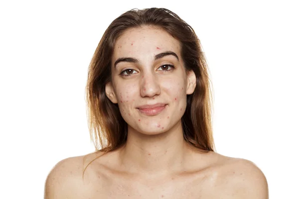 Jeune Femme Souriante Avec Peau Problématique Sans Maquillage Posant Sur — Photo