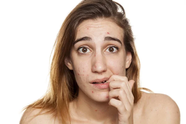 Mujer Joven Preocupada Con Piel Problemática Sin Maquillaje Posando Sobre — Foto de Stock