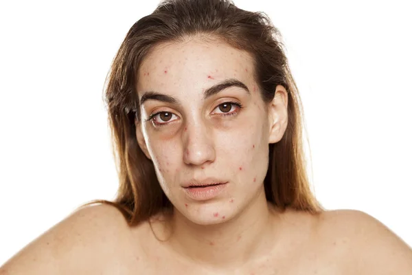 Tired Girl Problematic Skin Dark Circles Her Eyes Drugs Addiction — Stock Photo, Image